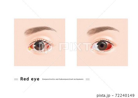 結膜炎 結膜下出血 目やに 症状 女性 顔 目 充血 赤い アレルギー 眼科 症例 イラストのイラスト素材 [72240149] - PIXTA