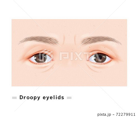 眼瞼下垂 両眼 シワ 小皺 女性 顔 目 眠たい まぶた 下垂 眼科 症例 イラストのイラスト素材