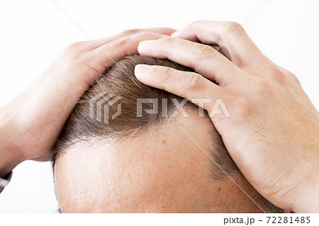 抜け毛 抜け毛 72281485