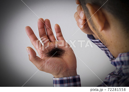 抜け毛 抜け毛 72281558