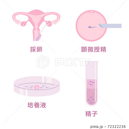 体外受精 72322236