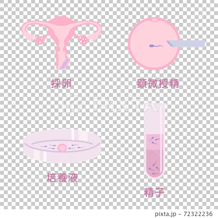 体外受精 72322236