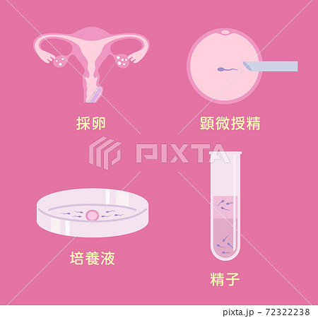 体外受精 体外受精 72322238
