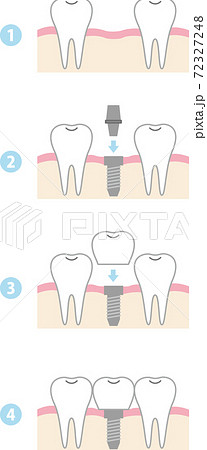 インプラント治療の流れのイラスト素材
