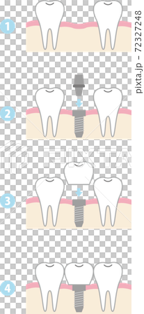 インプラント治療の流れ インプラント治療の流れ 72327248
