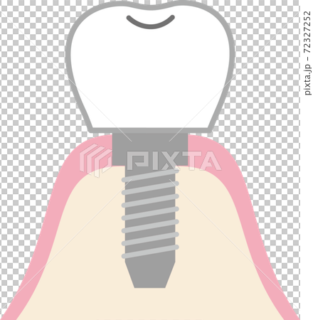 インプラントの構造のイラスト素材