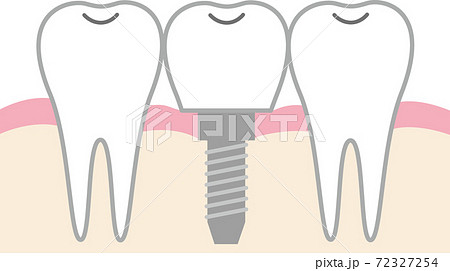 インプラントの構造のイラスト素材