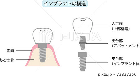 インプラントの構造 72327256