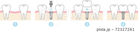 インプラント治療の流れ インプラント治療の流れ 72327261