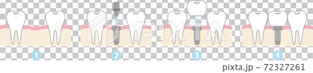 インプラント治療の流れ インプラント治療の流れ 72327261