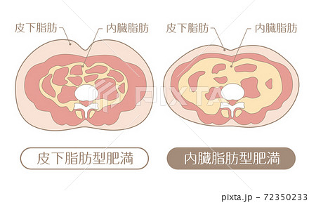 肥胖型皮下脂肪和內臟脂肪 插圖素材 圖庫