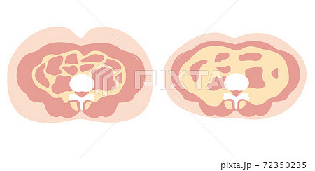 肥満のタイプ 皮下脂肪と内臓脂肪のイラスト素材