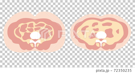 肥満のタイプ　皮下脂肪と内臓脂肪 72350235