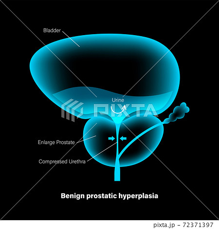 BPH info concept BPH info concept 72371397