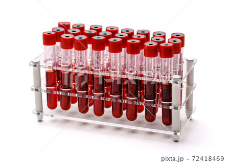 A rack of vacuum venipuncture test tubes filled with blood samples Isolated on a while background A rack of vacuum venipuncture test tubes filled with blood samples Isolated on a while background 72418469