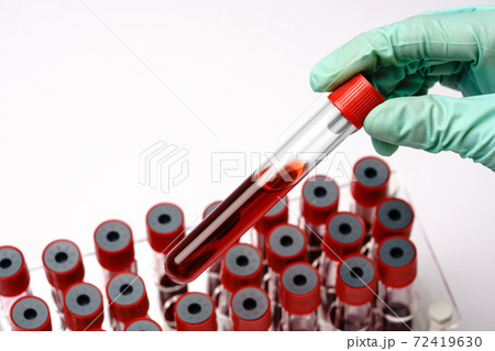 hands of a lab technician with a test tube of blood sample and a rack with other samples over light grey background hands of a lab technician with a test tube of blood sample and a rack with other samples over light grey background 72419630