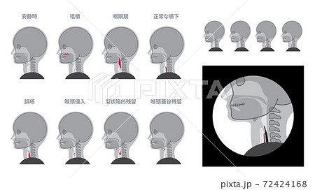 VF_嚥下造影検査のイラスト素材セット_赤 72424168