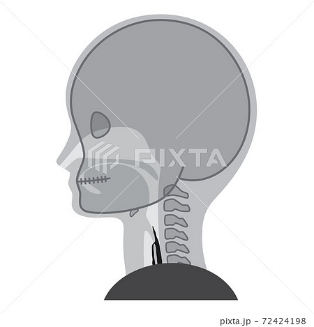 Vf 嚥下造影検査のイラスト 誤嚥のイラスト素材