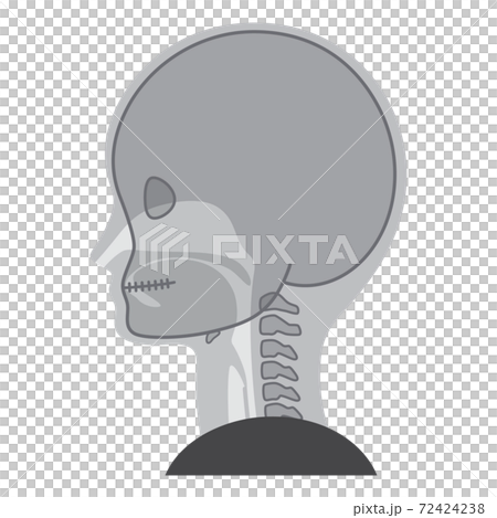 VF_Illustration of swallowing contrast examination_Swallowing VF_Illustration of swallowing contrast examination_Swallowing 72424238