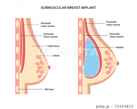 Breast Implant Concept 72424872
