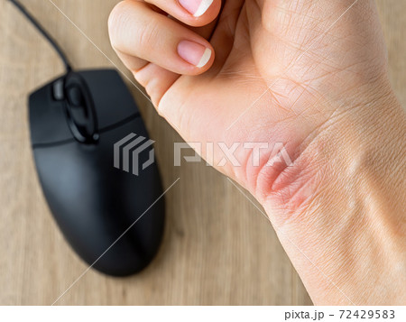Redness and callus on the wrist of a caucasian woman's hand, caused by long work at the computer. 72429583