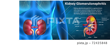 Medical infographic of kidney glomerulosclerosis 72435848