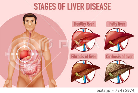 Stages of liver disease 72435974