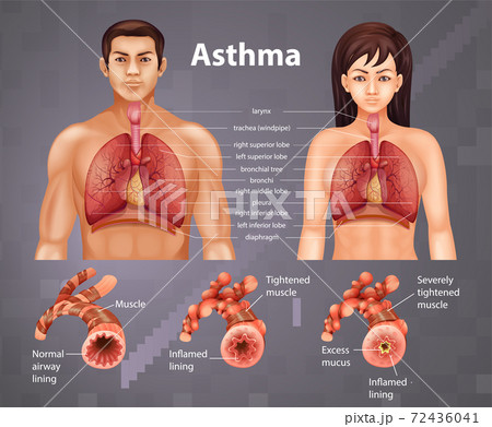 Comparison of healthy lung and Asthmatic lung Comparison of healthy lung and Asthmatic lung 72436041