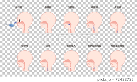 Illustration set of swallowing process and aspiration findings 72458755