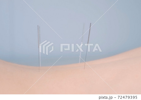 Woman on acupuncture treatment with needles inserted in her back, side iew. Woman on acupuncture treatment with needles inserted in her back, side iew. 72479395