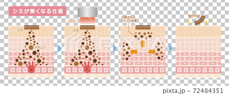 皮膚斑點治療激光治療 72484351