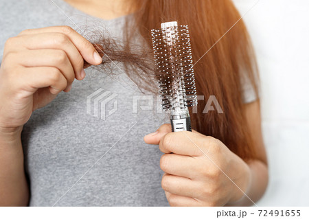 A woman with hair loss, she's allergic to shampoo and conditioner. A woman with hair loss, she's allergic to shampoo and conditioner. 72491655