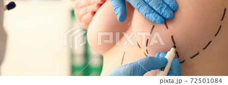 Surgeon drawing lines on young woman breast 72501084