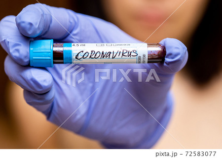 Blood sample tube positive with 2019-nCoV, novel coronavirus 2019 found in Wuhan, China Blood sample tube positive with 2019-nCoV, novel coronavirus 2019 found in Wuhan, China 72583077