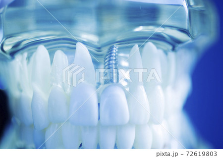 Dental tooth implant model Dental tooth implant model 72619803
