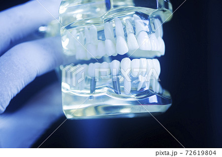 Dental tooth implant model Dental tooth implant model 72619804