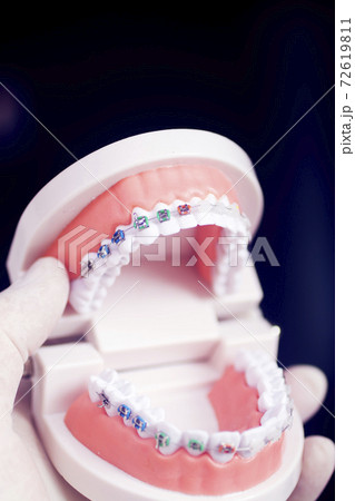 Dental teeth aligners brackets Dental teeth aligners brackets 72619811