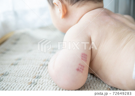 窓辺にいる腕にBCGの痕がある赤ちゃん 72649283