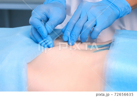 Man doctor acupuncturist in gloves inserts acupuncture needle to woman abdomen. Man doctor acupuncturist in gloves inserts acupuncture needle to woman abdomen. 72656635