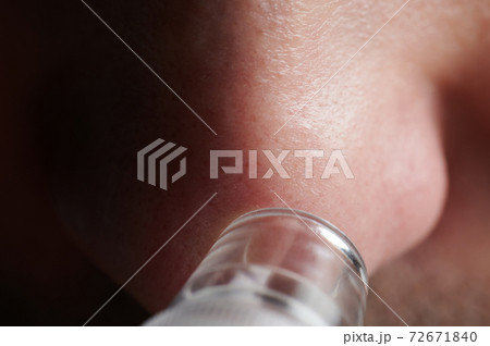 Blackhead skin treatment 72671840