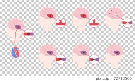 Illustration material set of the cause of stroke_cerebral infarction_cerebral hemorrhage 72713560
