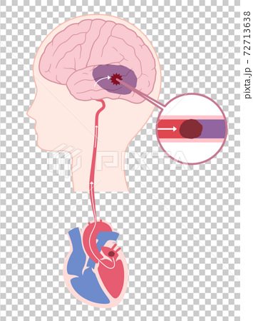 心原性脳梗塞のイラスト 脳塞栓のイラスト素材
