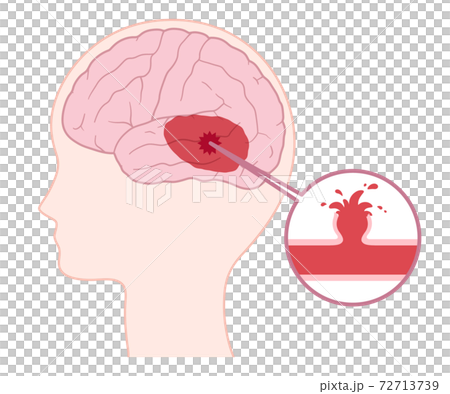 脳動脈瘤破裂のイラスト 脳動脈瘤破裂のイラスト 72713739
