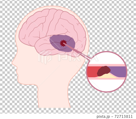 アテローム血栓性脳梗塞のイラスト アテローム血栓性脳梗塞のイラスト 72713811