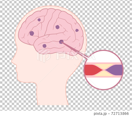 腔隙性梗塞的插圖 腔隙性梗塞的插圖 72713866