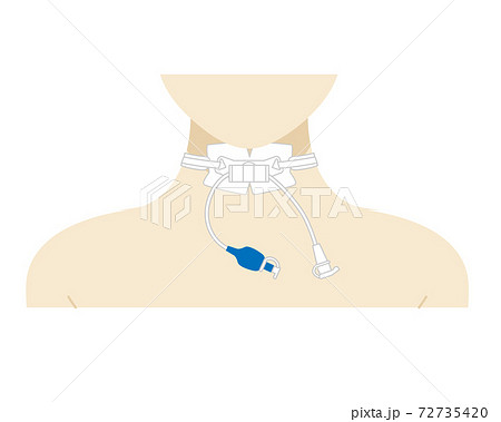 気管切開 気管切開 72735420