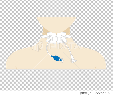 気管切開 気管切開 72735420