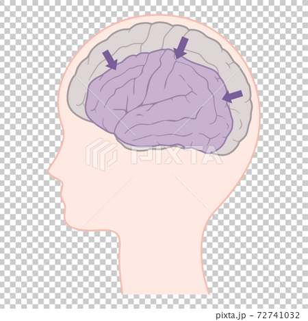 脳萎縮 アルツハイマー型認知症の脳のイラストのイラスト素材