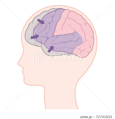 前頭側頭型認知症の脳のイラスト 前頭葉と側頭葉の萎縮のイラスト素材