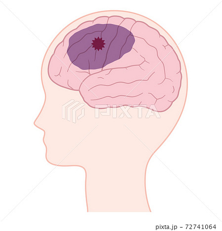 脳血管性認知症の脳のイラストのイラスト素材